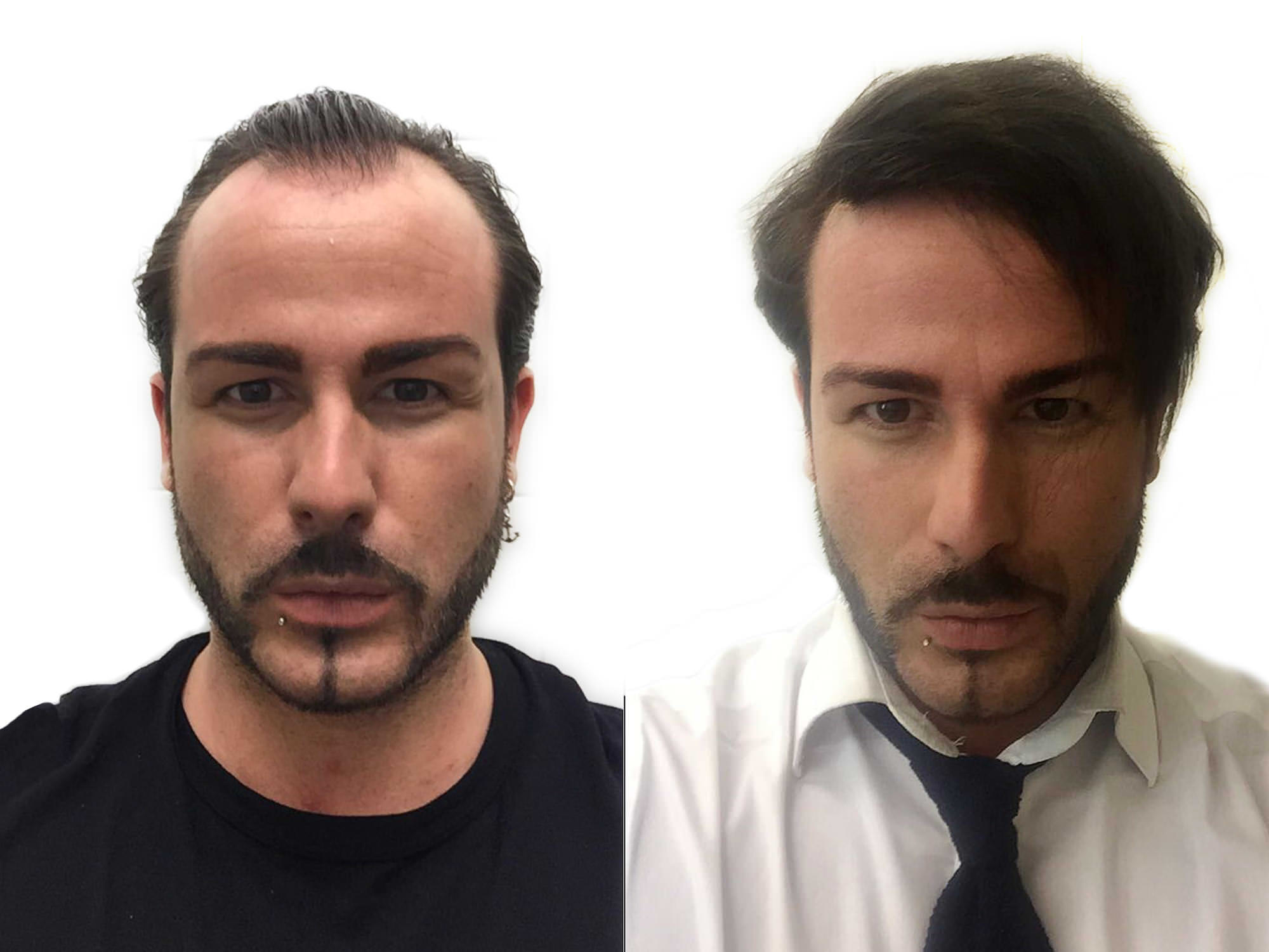 fasi di un trapianto capelli fue