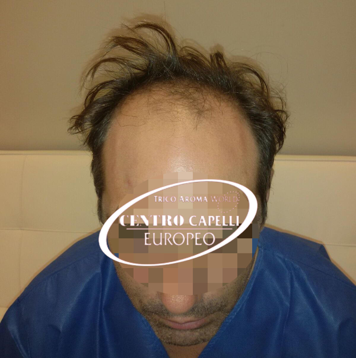 trapianto fue - prima