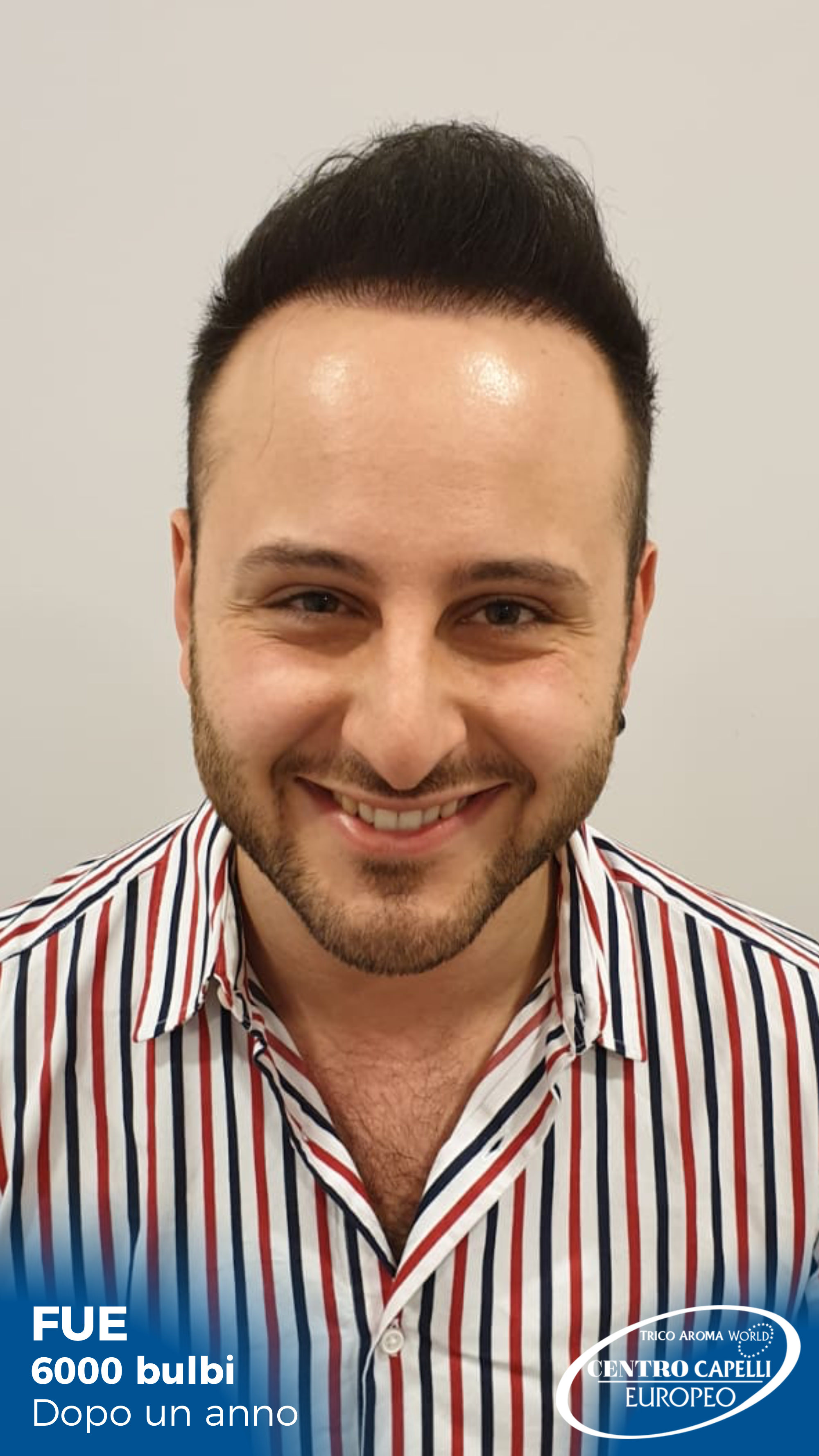 Foto dopo un anno dal trapianto di capelli FUE a catania 6000 bulbi