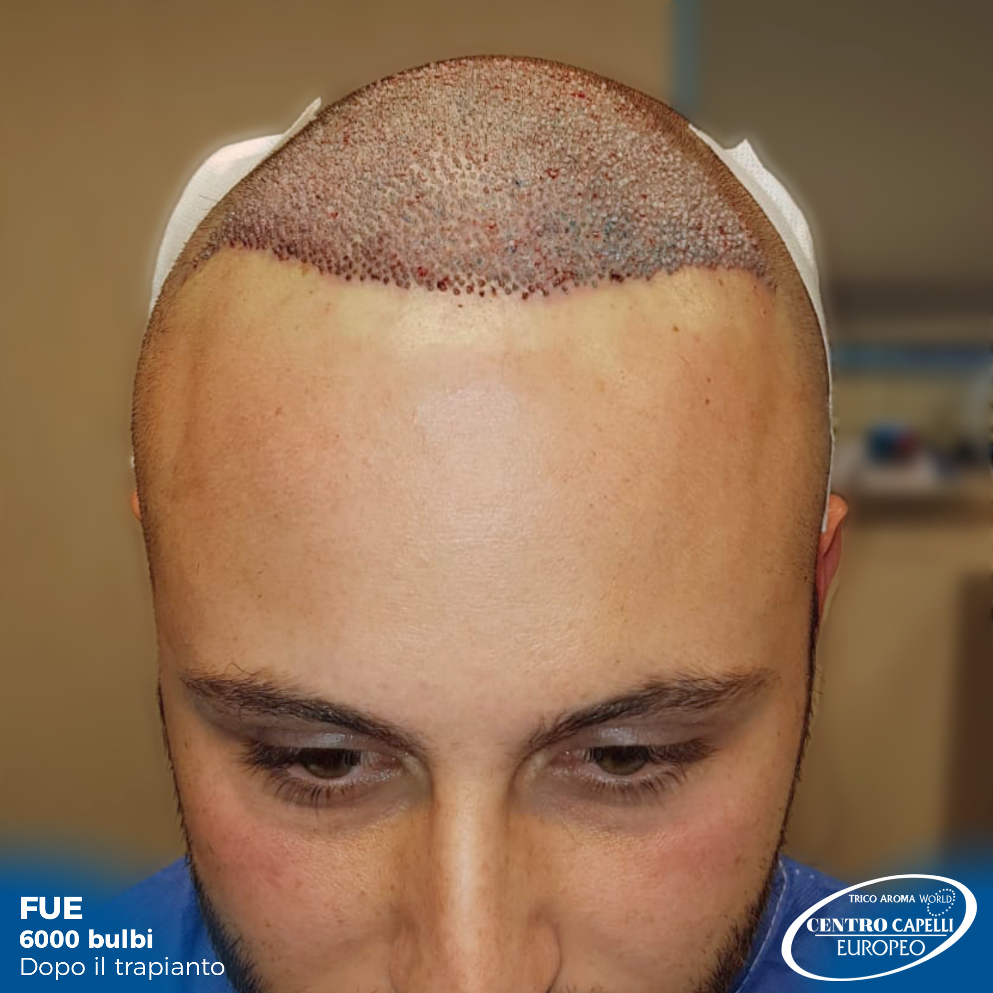 Foto dopo il trapianto di capelli FUE a catania 6000 bulbi