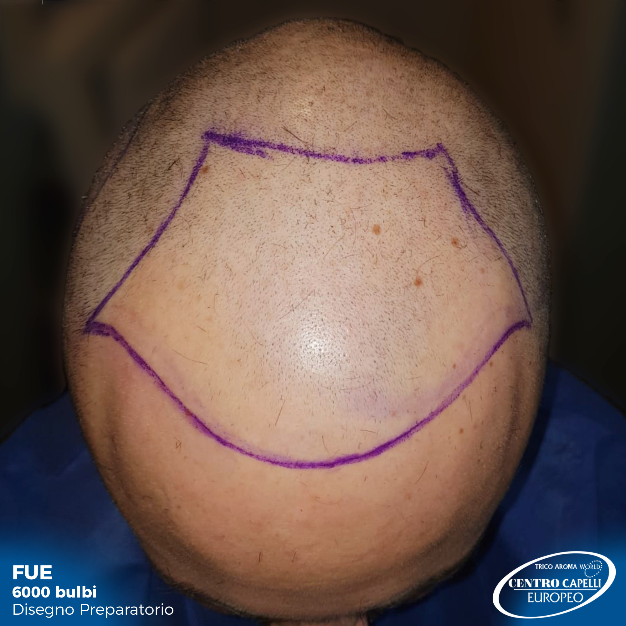 Foto di prima del trapianto di paziente sottoposto a trapianto capelli FUE a catania 6000 bulbi