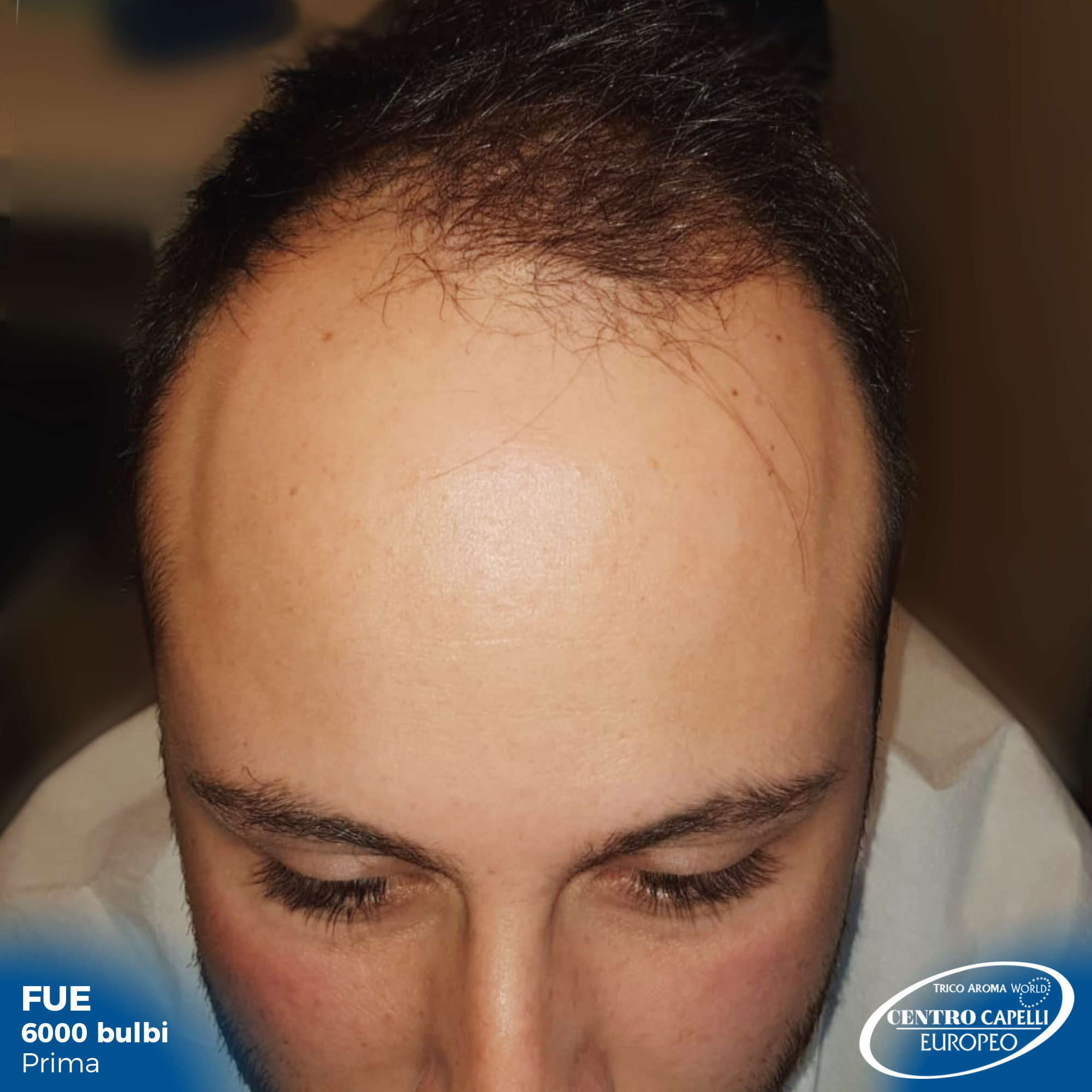 Foto di prima di paziente sottoposto a trapianto capelli FUE a catania 6000 bulbi