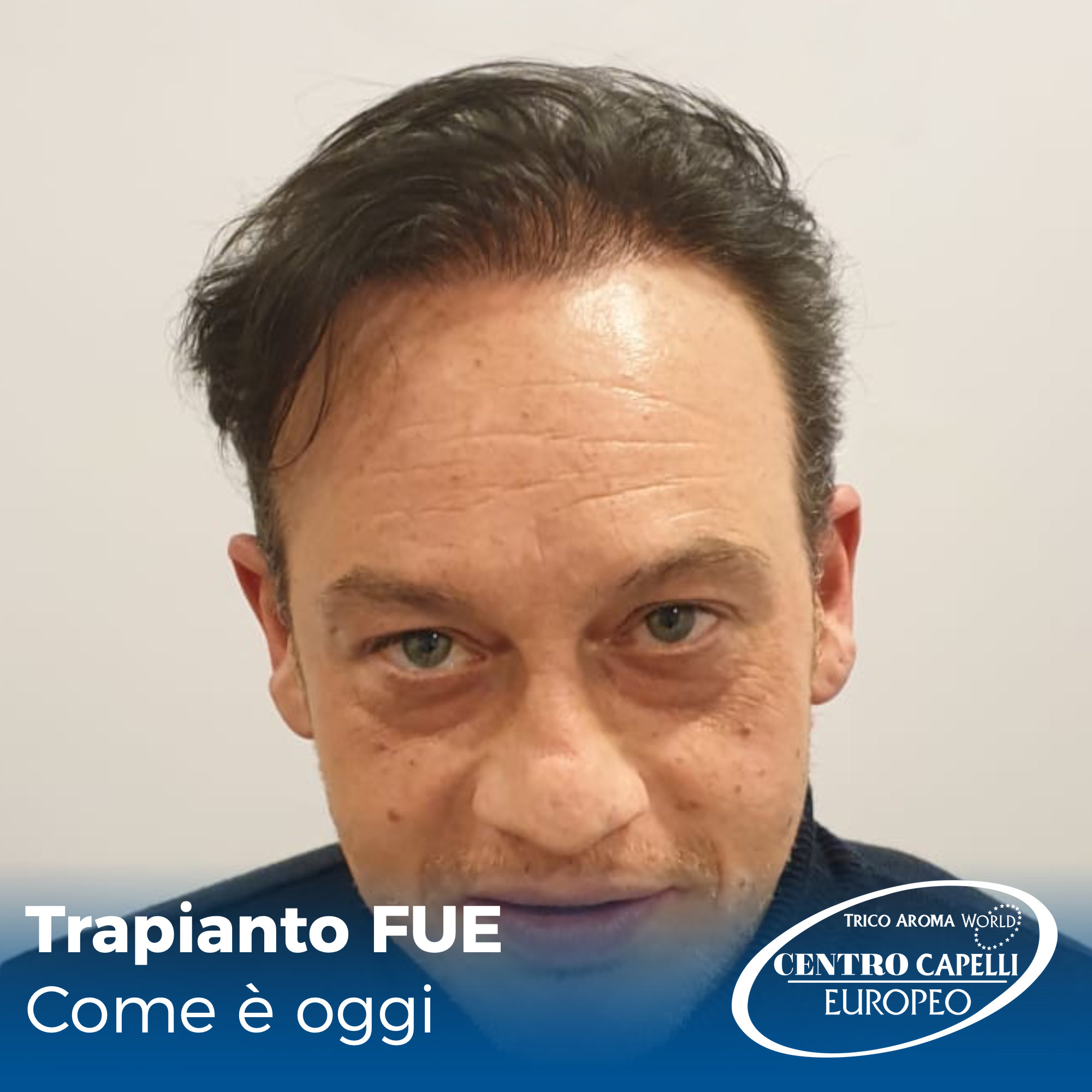 Foto del paziente sottoposto ad un trapianto di capelli FUE a catania