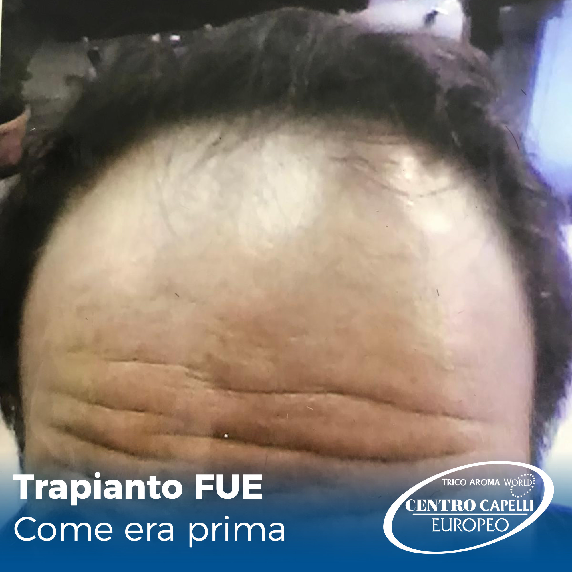 Foto del paziente prima di sottoporsi a trapianto capelli FUE a catania 6000 bulbi