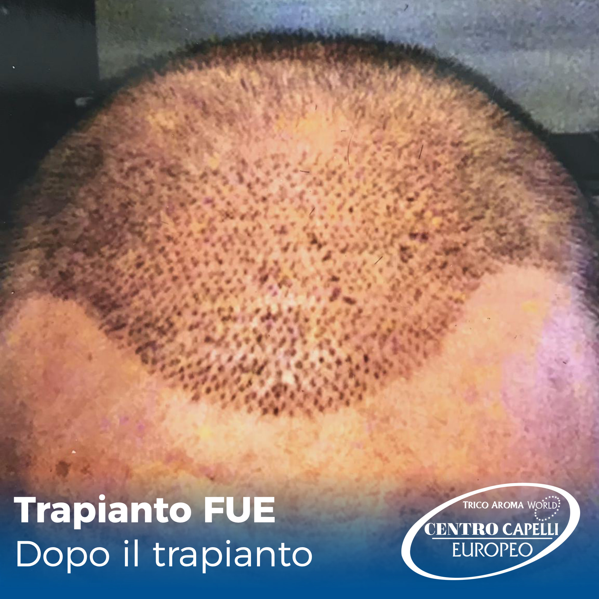 Foto del paziente appena sottoposto ad un trapianto di capelli FUE a catania