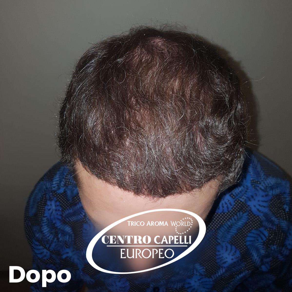 Post%20paziente%20FUE%20Dopo