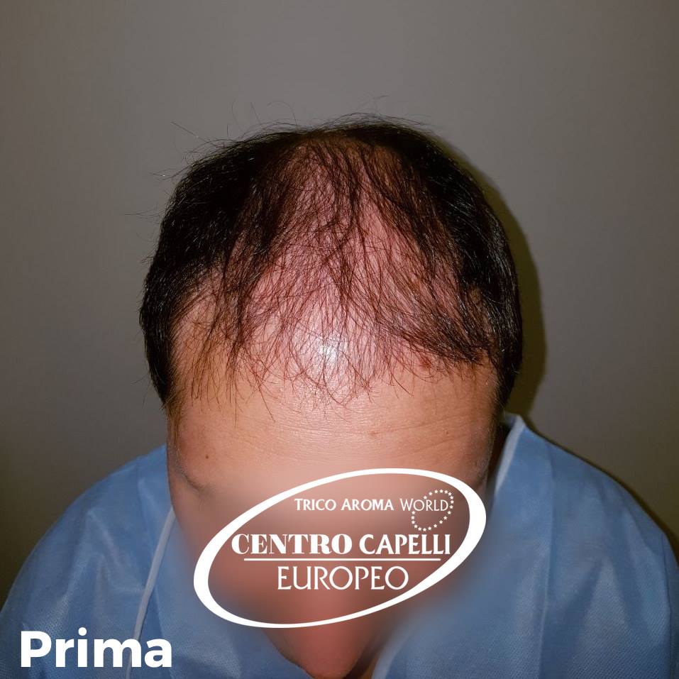 Post%20paziente%20FUE%20Prima