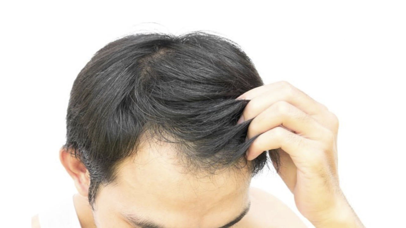 Protesi per capelli: è la soluzione più adatta a te?