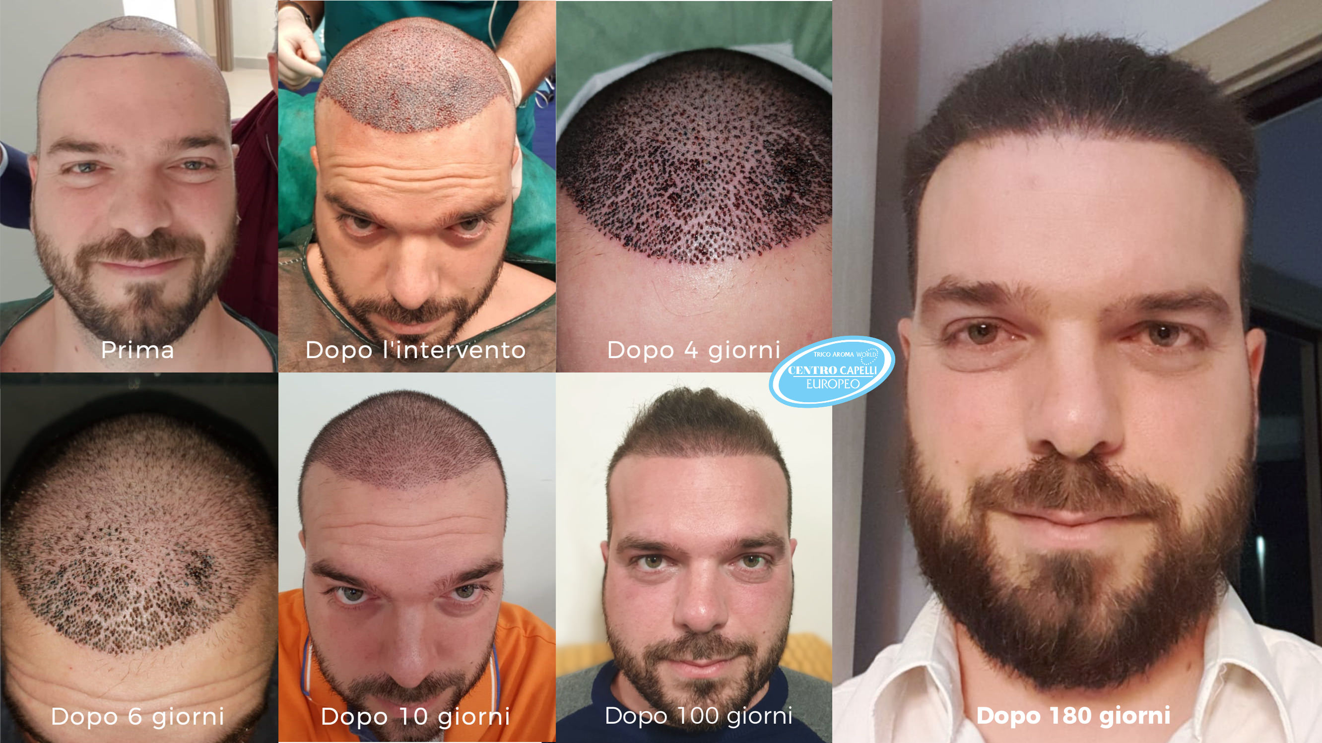 fasi di un trapianto capelli fue