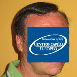 Paziente dopo un anno dal trapianto FUE