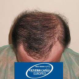 Paziente dopo un mese dal trapianto FUE