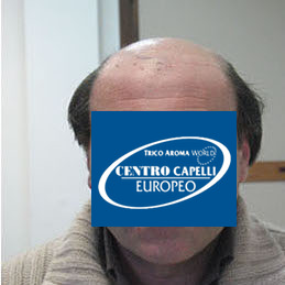 Paziente prima del trapianto FUE