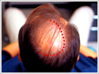 zona calva per calvizie androgenetica