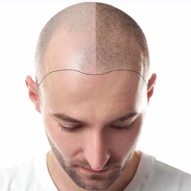 tricopigmentazione capelli