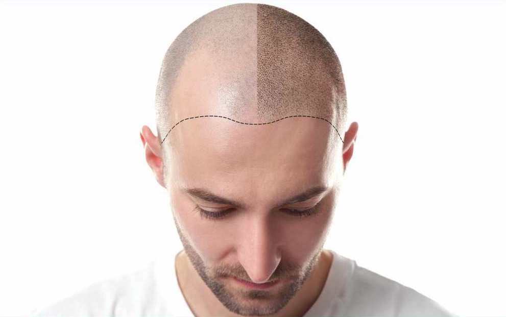 tricopigmentazione 05