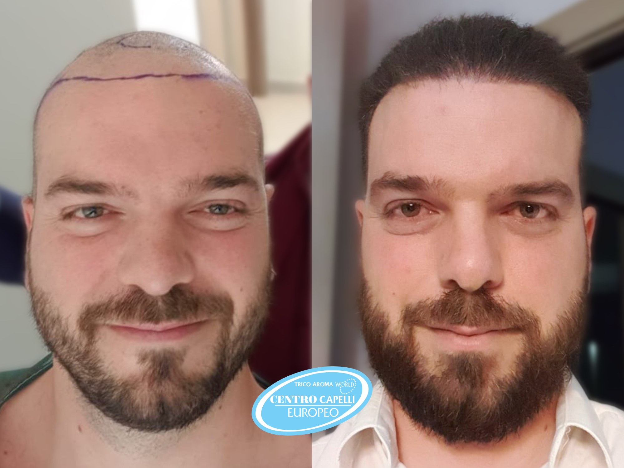 prima e dopo di trapianto capelli fue