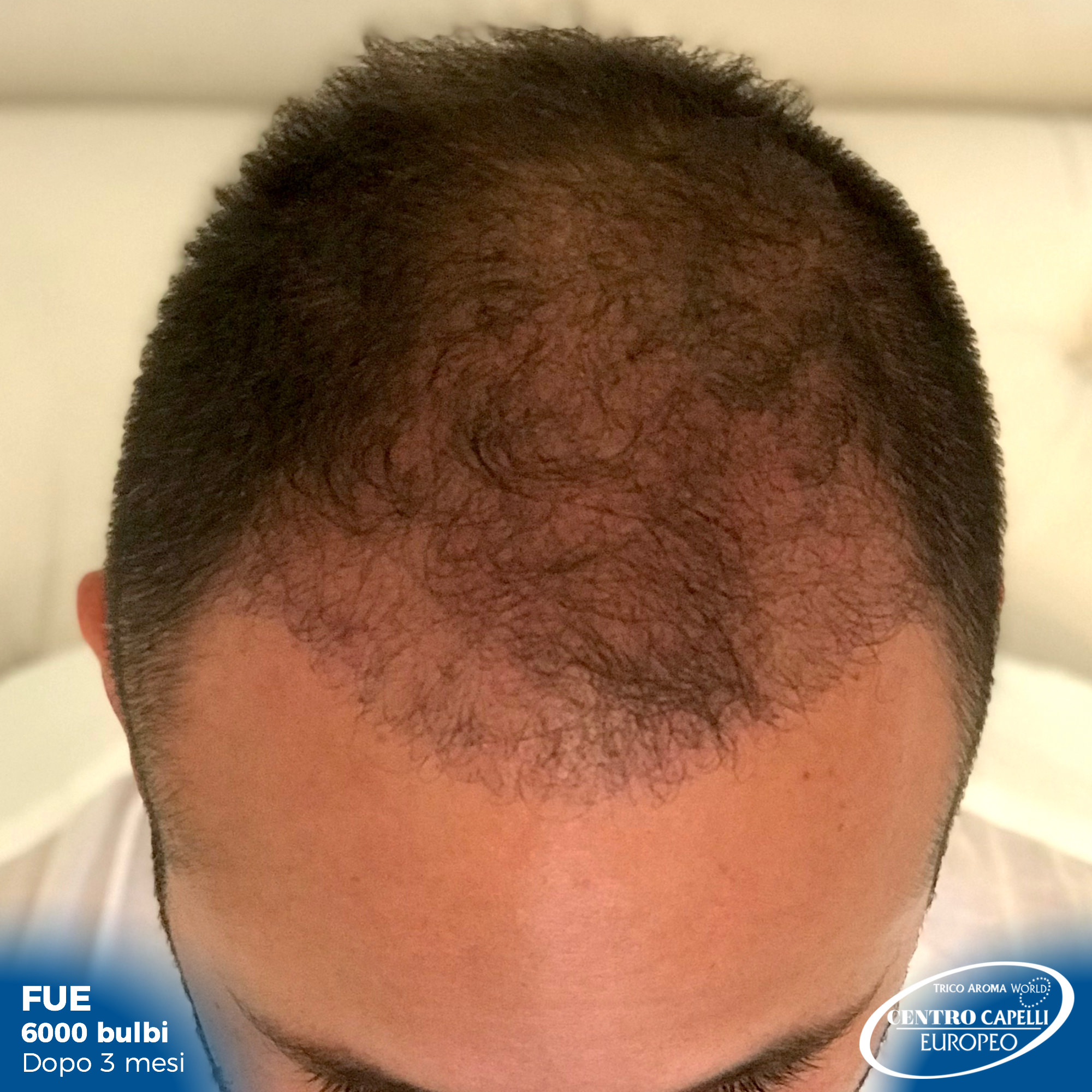 Foto dopo 3 mesi dal trapianto di capelli FUE a catania 6000 bulbi