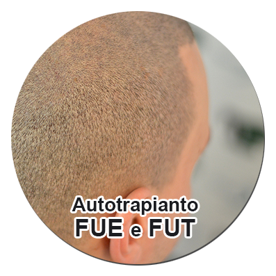 trapianto capelli fue